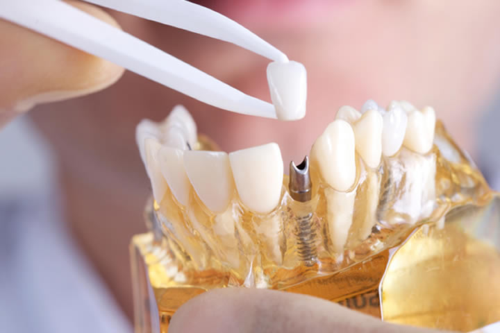 DENTAL IMPLANTS NYC