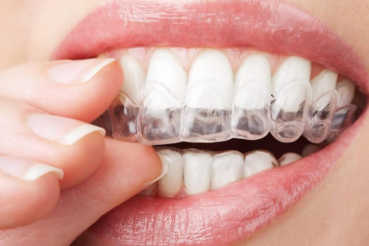 INVISALIGN NYC